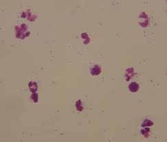 Die malaria ist die häufigste tropenkrankheit mit jährlich mehr als 3 millionen neuerkrankungen. Dicker Tropfen Giemsa Farbung Fixierung Dauerpraparate