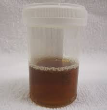 Scar tissue in the ureters or urethra. Rhabdomyolysis Wikipedia
