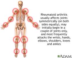 rheumatoid arthritis case studies show diet success