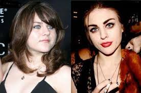 Cobain also began using heroin around this time. Frances Bean Cobain Plastic Surgery Before And After Hair Implants Celebrity Plastic Surgery Plastic Surgery Photos