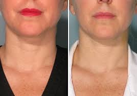 Belotero Dermal Filler For Saggy Necks Dermal Fillers Botox Fillers Facial Fillers