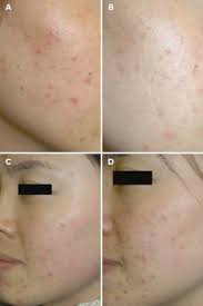 Red Light Therapy Benefits For Acne Wrinkles Pigmentation And More The Skincare Edit