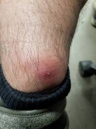 The hair follicle is where the genital hairs seen on a female vulva grows from. Ouch Spider Bite Or Ingrown Hair Day 3 Or 4 Album On Imgur