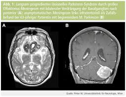 Neuroimaging Bei Parkinson Syndromen Medmedia