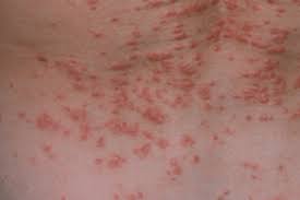 Image result for scabies human bites