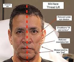 What are the advantages of having a thread lift instead of a facelift? For  many patients, the biggest advantage of having a thread lift rather than a  facelift is the greatly reduced