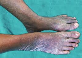 Image result for Lichen Simplex Chronicus