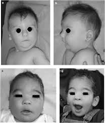 Molecular Cytogenetic Characterization Of Terminal 14q32 Deletions In Two Children With An Abnormal Phenotype And Corpus Callosum Hypoplasia European Journal Of Human Genetics