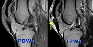 We did not find results for: The Radiology Assistant Non Meniscal Pathology