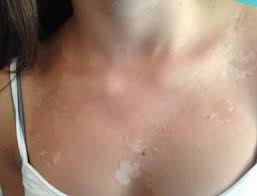Spray Tan Disasters