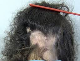 It may happen on any part of the body. Alopecia Areata American Hair Research Society