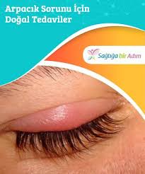 Arpacik Sorunu Icin Dogal Tedaviler Gozun Etrafinda Sisme Varsa Arpacik Cikmis Olabilir Genellikle Agri Yapmaz An Natural Treatments Sense Of Life Treatment