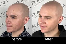 Scalp micropigmentation helps restore confidence in men & women who are struggling with thinning hair. The Scalp Micropigmentation Journey With John Schedule A Free Consult