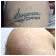 Insurance companies will not cover laser tattoo removal, as it is considered an elective cosmetic procedure. Safe And Professional Tattoo Removal In Massachusetts New York City