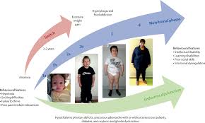 Endocrine Disorders In Prader Willi Syndrome A Model To Understand And Treat Hypothalamic Dysfunction The Lancet Diabetes Endocrinology