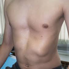 It is also known as pigeon chest or keel chest. Pectus Excavatum Surgery Preparation And Recovery