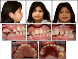 Blood diseases, bone diseases, eye diseases, fetal diseases, genetic diseases, oral diseases, rare diseases, skin diseases. Orthodontic Management Of A Patient With Cherubism A Case Report American Journal Of Orthodontics And Dentofacial Orthopedics