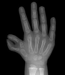 Image result for Polydactyly