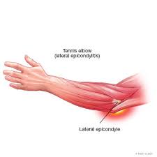 Tennis elbow, or lateral epicondylitis, is a painful condition of the elbow caused by overuse. Tennis Elbow Lateral Epicondylitis Mayo Clinic Orthopedics Sports Medicine