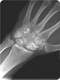 Image result for Scapholunate Dislocation