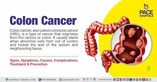 Image result for Constipation in Cancer