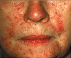 Image result for Demodex brevis