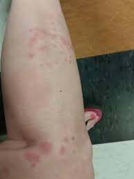 Why do bug bites burn? Kissing Bugs Pucker Up In Redding But Disease Rare