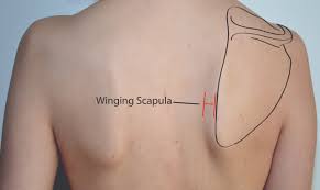 Image result for Winged Scapula