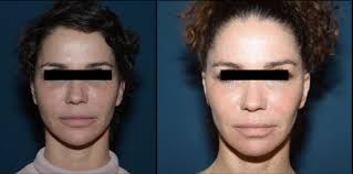 Volumétrie frontotemporale pour rajeunir et re-féminiser le visage