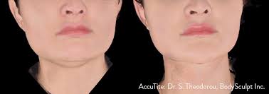 Embrace rf by inmode encompasses their facetite (percutaneous bipolar rf) treatment followed by the new morpheus 8 (microneedling rf). Skin Rejuvenation Resurfacing Contouring Inmode Diepenbrock Facial Cosmetic Surgery