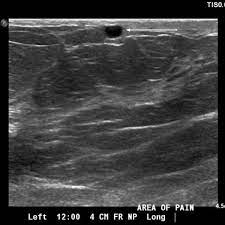 Mondor's disease is the chronic inflammation (thrombophlebitis) of superficial veins of thoracoabdominal or thoraco epigastric region. Mondor S Disease Of The Breast An Uncommon Cause Of Atypical Chest Pain Eurorad