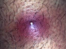 An ingrown hair that sometimes turns into sizes almost. Staphylococcal Skin Infection Dermnet Nz