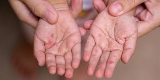 Image result for Hand foot and mouth disease HFMD roof of mouth