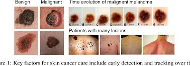 01.07.2021 · while early detection and treatment of skin cancer can improve patient outcomes,4 convincing data regarding the benefit of mass screening programs are lacking.5 in … Pdf Skin Cancer Detection And Tracking Using Data Synthesis And Deep Learning Semantic Scholar