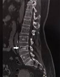 Image result for Low Back Imaging
