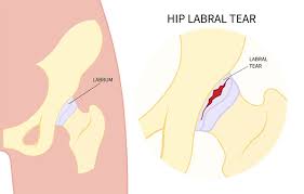 Image result for Hip Labral Tear