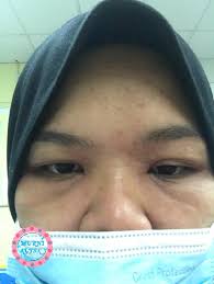 Puncanya hadir dalam pelbagai aspek antaranya kulit wajah selalu terdedah pada cahaya matahari, salah guna produk atau pemilihan makanan yang kurang sesuai. Muka Naik Ruam Teruk Part 1 Alahan Mengandung Di Trimester Ke 2 Coretan Murni Alysa