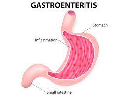 Symptoms may include diarrhea, vomiting and abdominal pain. Gastroenteritis