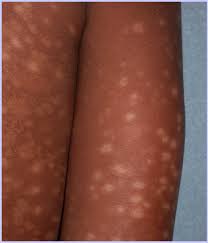 Image result for Postinflammatory Hypopigmentation