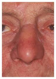 ﻿ ﻿﻿﻿﻿ the two most common types of skin cancer that develop on the nose are basal cell carcinoma (bcc) and squamous cell carcinoma (scc). A Multifocal Nasal Skin Cancer Flap Design B Skin Defect After Download Scientific Diagram