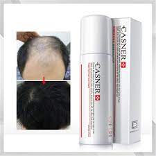 Nioxin's hair regrowth treatment with minoxidil uses this active ingredient to address the signs of hair thinning and loss. Wholesale Private Label Organic Anti Hair Loss Oil Spray Thinning Hair Growth Serum For Hair Loss Treatment Buy Hair Growth Serum Hair Growth Spray Anti Hair Loss Product On Alibaba Com