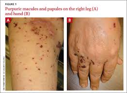 The lesions are small, darkly pigmented papules that are harmless and generally don't require treatment. Purpuric Lesions In An Elderly Woman Pulmonary Health Hub