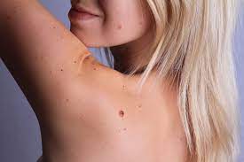 Check for bccs where your skin is most exposed to the sun, especially the face, ears, neck, scalp, chest, shoulders and back, but remember that they can occur anywhere on the body. Melanoma Pictures Symptoms What Does Melanoma Look Like