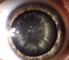 Cataracts often develop slowly and can affect one or both eyes. Grauer Star Katarakt Infos Aus Der Augenarztpraxis Ettlingen