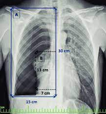 The definition of a pneumothorax is an accumulation of air outside the lungs, but inside the chest wall. Calculation Of The Size Of Pneumothorax Using The Method Defined By Download Scientific Diagram