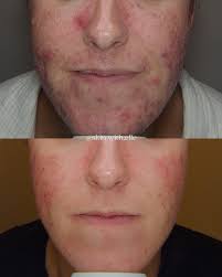 We are absolutely obsessed with our beautiful client's progress🥹 Clear  skin takes time but it is SO worth it. The time difference between these  photos is just a little under 5 months.