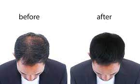 We have provided visible results to over 94% patients. Can Gro Hair Grow The Hair Dr Batra S