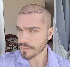 Ele recebeu 58,86% dos votos em um paredão contra arthur e pocah.confira o que o professor de geografia tem feito fora do confinamento.longe da sal Sidney Sampaio Posta Foto Com A Cabeca Machucada E Explica Fiz Um Transplante Capilar Estrelando