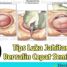 Kalau jahitan sudah sembuh, kesakitan yang anda rasa mungkin akan hilang selepas 6 minggu. Luka Jahitan Bersalin Terbuka Sampai Tak Boleh Jalan Mahupun Duduk