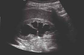 Renal depend on the position of the stone. What To Do With Incidental Kidney Lesions Pulse Today